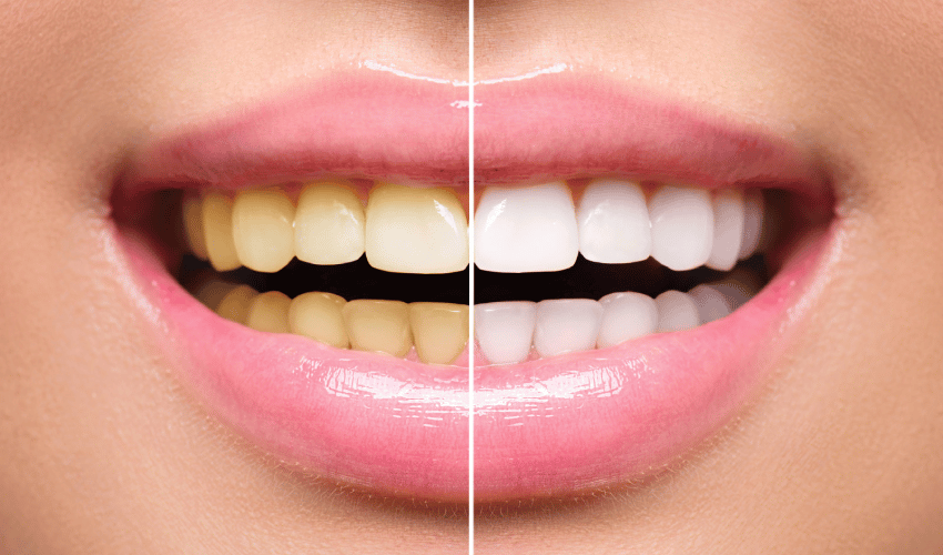 Effects of Over-Whitening Your Teeth