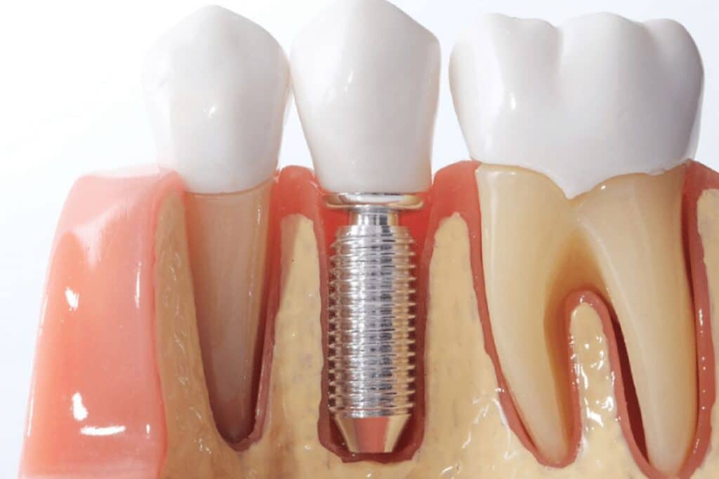 advantages of dental implants