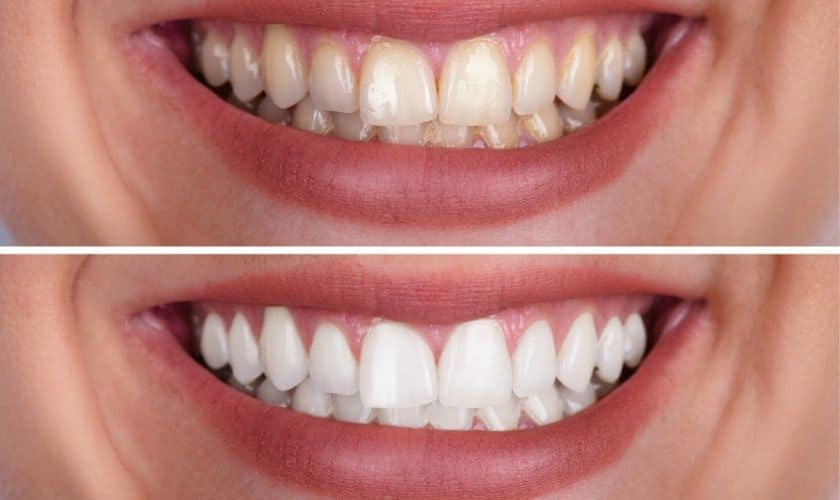 Teeth Whitening Magnolia