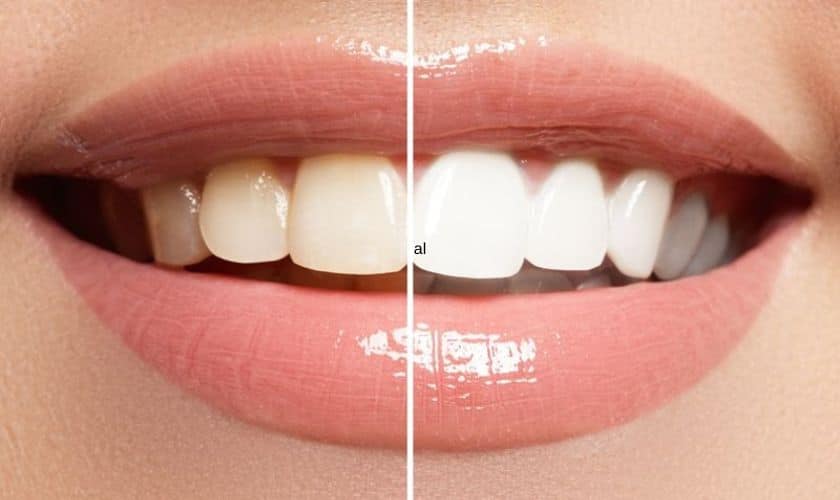 Teeth Whitening Magnolia