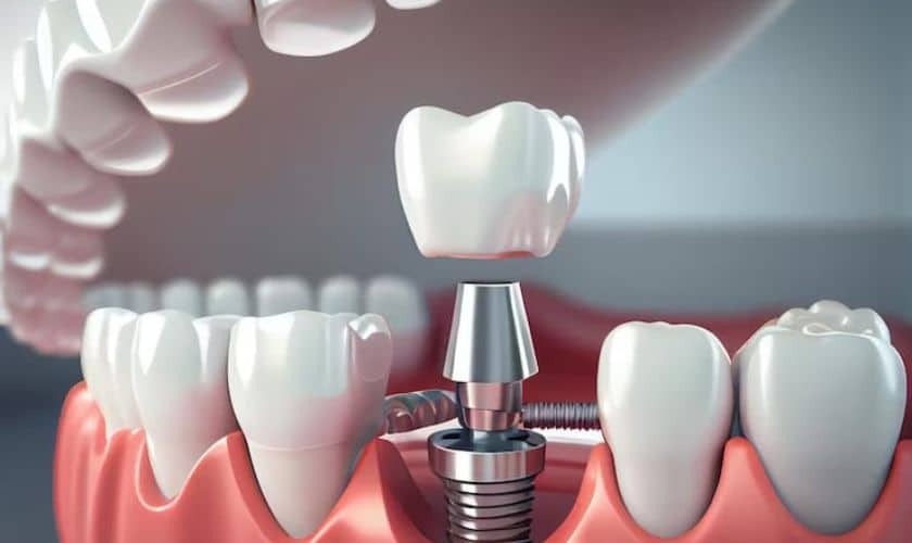 Dental Implants in Magnolia