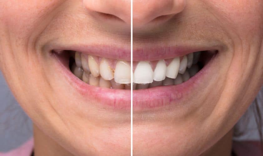 Teeth Whitening in Magnolia