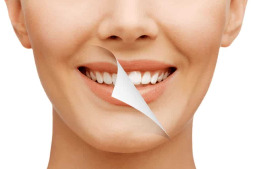 Teeth Whitening in Magnolia
