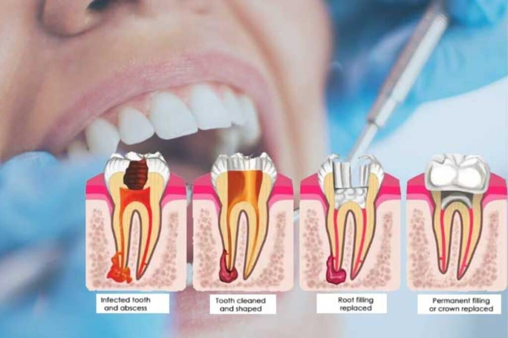 Root Canal Therapy in Magnolia