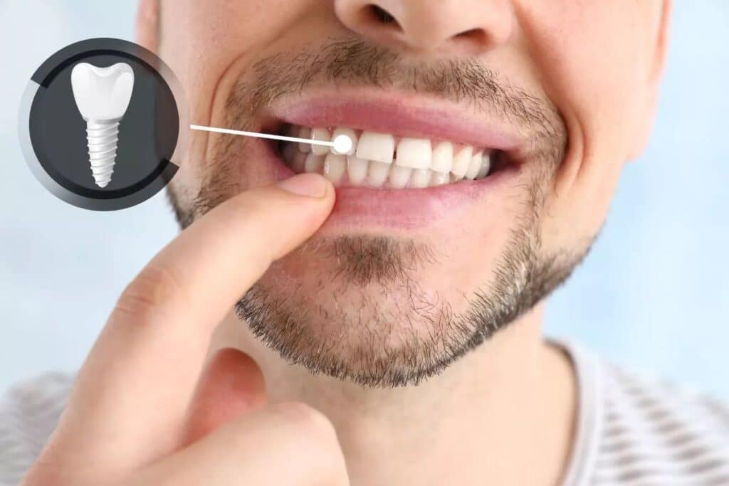 Dental Implants Magnolia