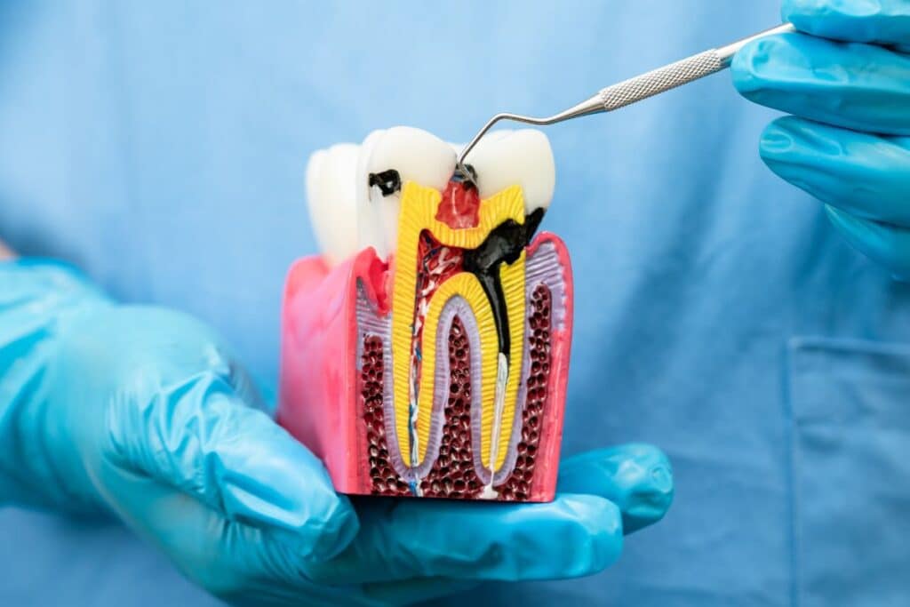 Root Canal Therapy Magnolia
