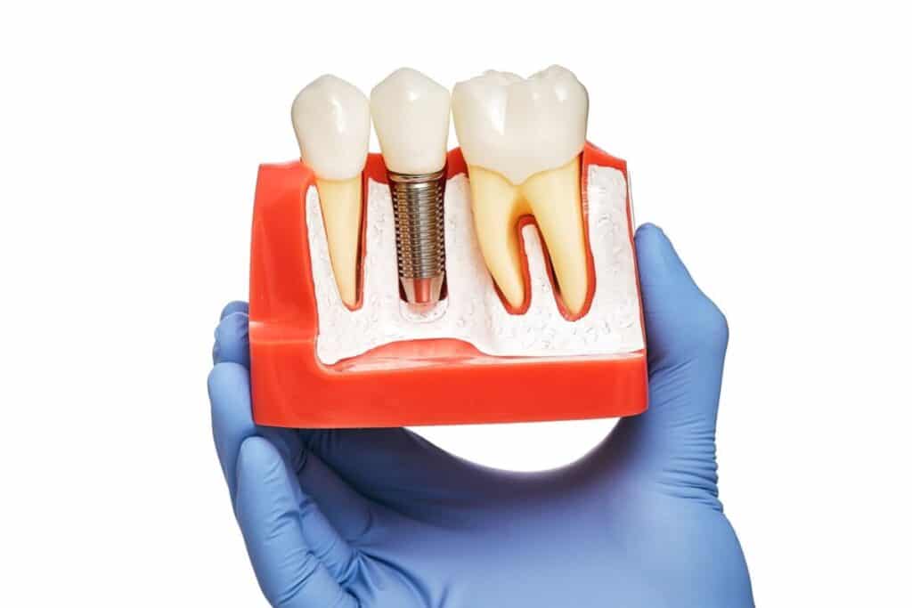 Dental Implants Magnolia