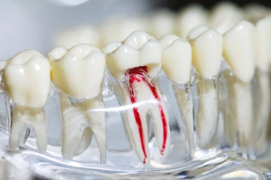 Root Canal Therapy Magnolia