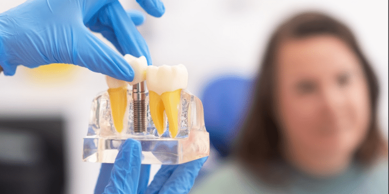 Take Care of Dental Implants