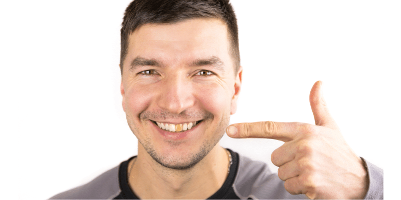 Porcelain Veneers Stain Like Natural Teeth
