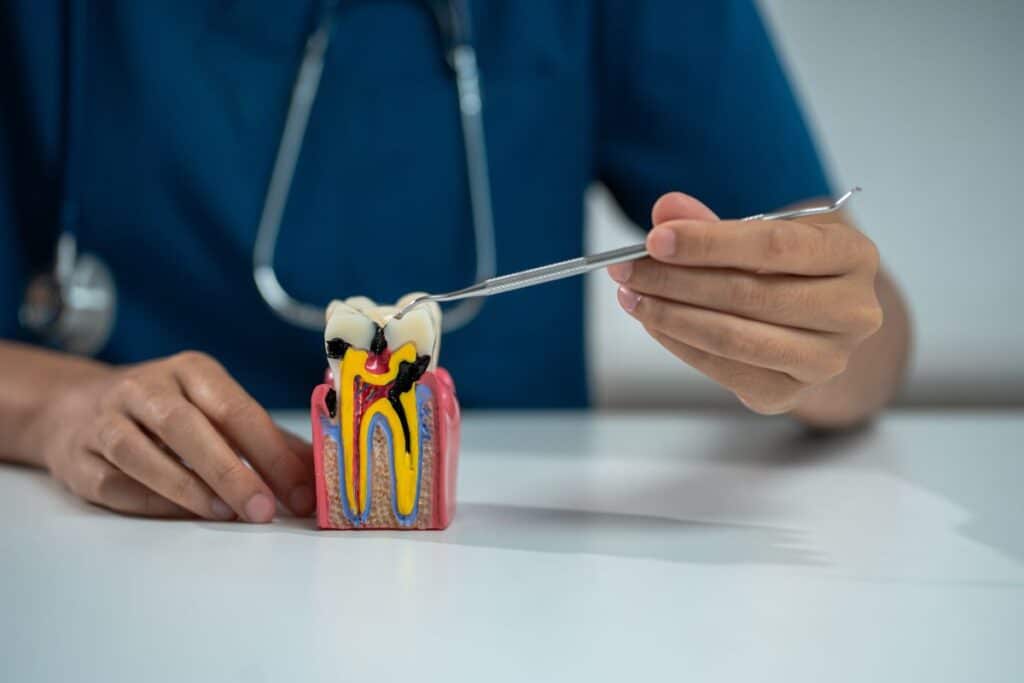 Dentist demonstrating tooth anatomy model with explorer tool to explain root canal treatment.
