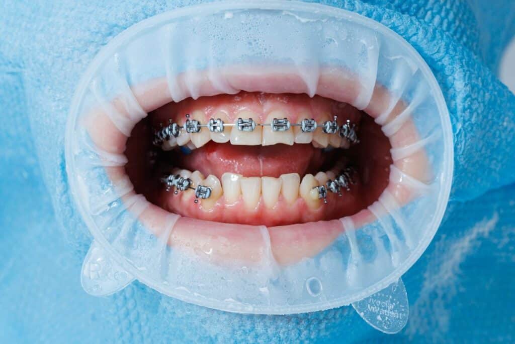 Close-up of upper and lower teeth with metal braces during orthodontic treatment.